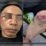 Steven Lonardo Sadia Alami Luka Memar dan Laporkan Kasus ke Polsek Koja Jakarta Utara